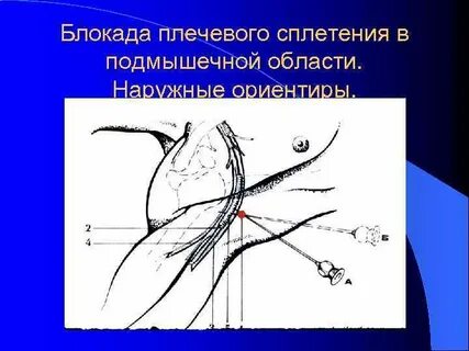 Нервная блокада