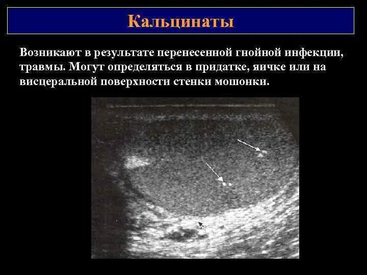 Кальцинат узи. Кальцинат узи