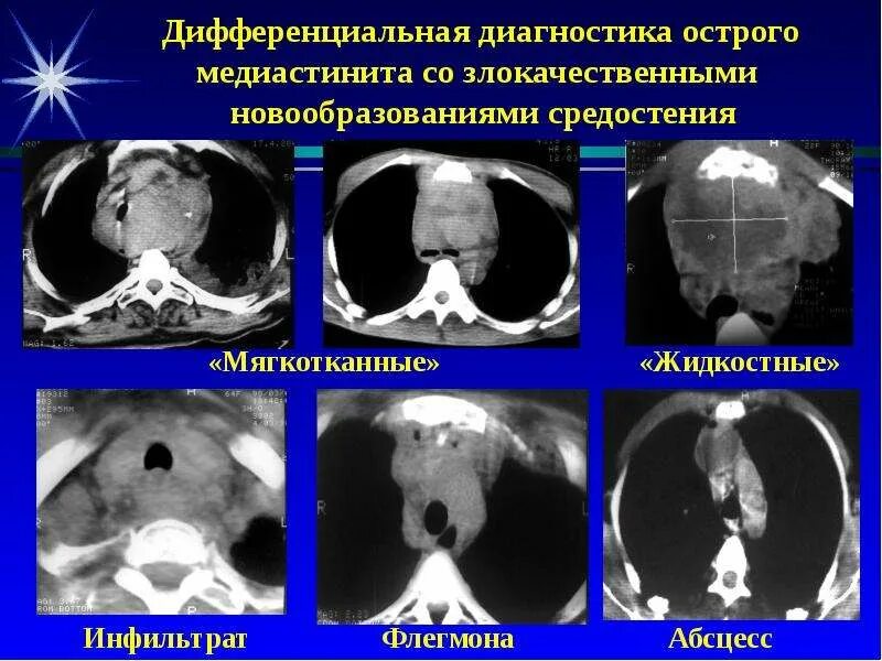 Медиастинит причины. Медиастинит кт картина. медиастинит этиопатогенез. острый гнойный медиастинит диагностика. образования средостения на кт.