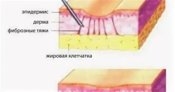 Процесс заживления шва. Рубцевание косметического шва.