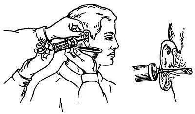 Серная пробка манипуляция. Промывание уха шприцом жане. Инородное тело слухового прохода промывание. Техника промывания наружного слухового прохода. Шприц жане для промывания ушей.