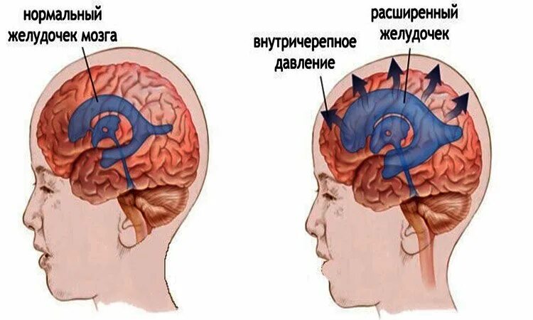 Повышенное давление головного мозга. Внутричерепное давление. гипертензия головного мозга. вунутирй черепной гипертензия. внутричерепная гипертензия давление.