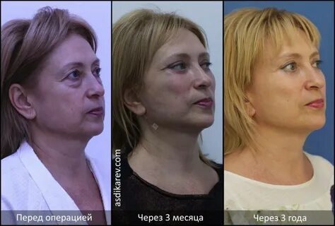 Смас хирургия