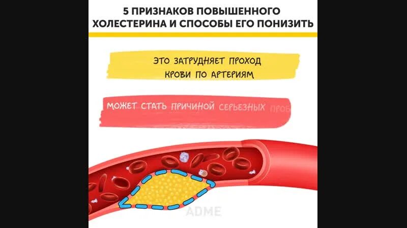 Симптомы повышенного холестерина. Признаки высокого холестерина. Повышенный холестерин симптомы. Проявление повышенного холестерина.