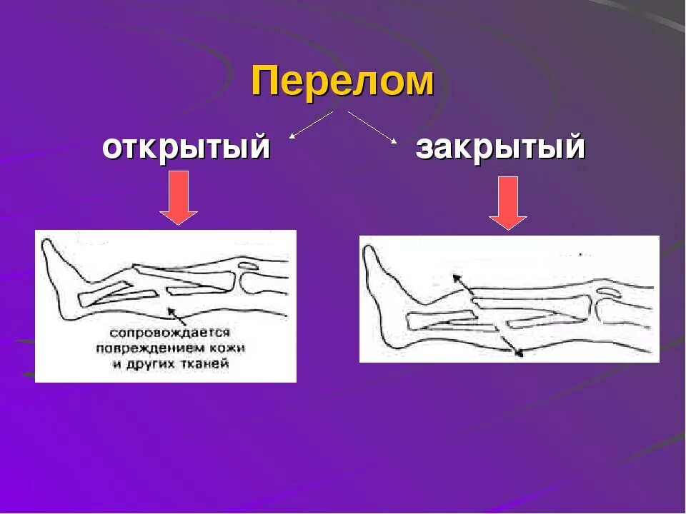 Закрытые трещины. Схема открытого перелома. Открытый перелом презентация. Что такое открытый перелом в биологии 8 класс.