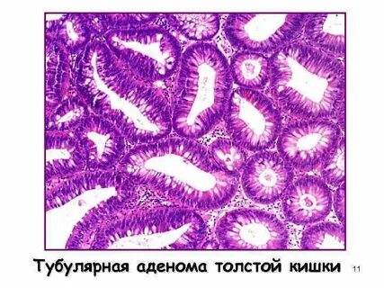 Зубчатая аденома с дисплазией low grade