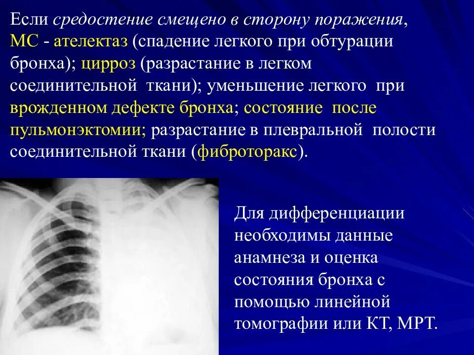 Спадение бронха