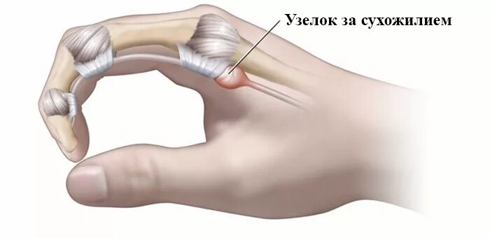 Код мкб гигрома кисти