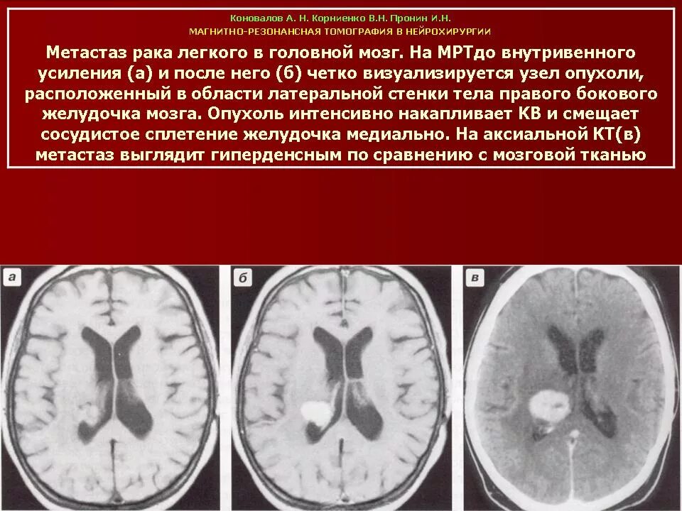 Метастазы головного мозга кт.