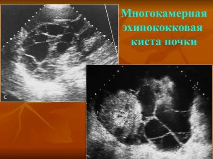 Синусные кисты обеих