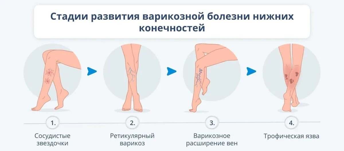 Диагноз расширение вен. Варикозное расширение вен (ВРВ) нижних конечностей. Стадии развития варикозной болезни нижних конечностей. Варикозное расширение вен нижних конечностей 1-2 степени. Венозное расширение вен нижних конечностей клиника.