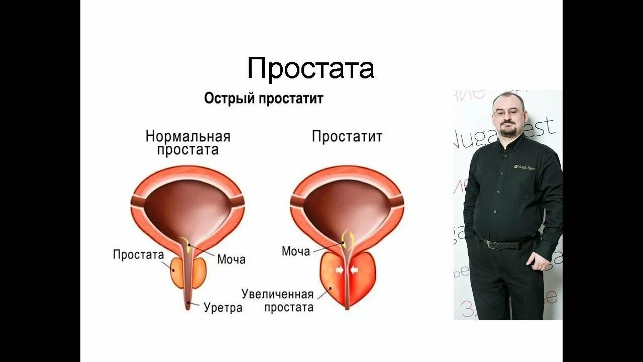 Чем отличается простатит от простатита. Мочеиспускание при простатите.