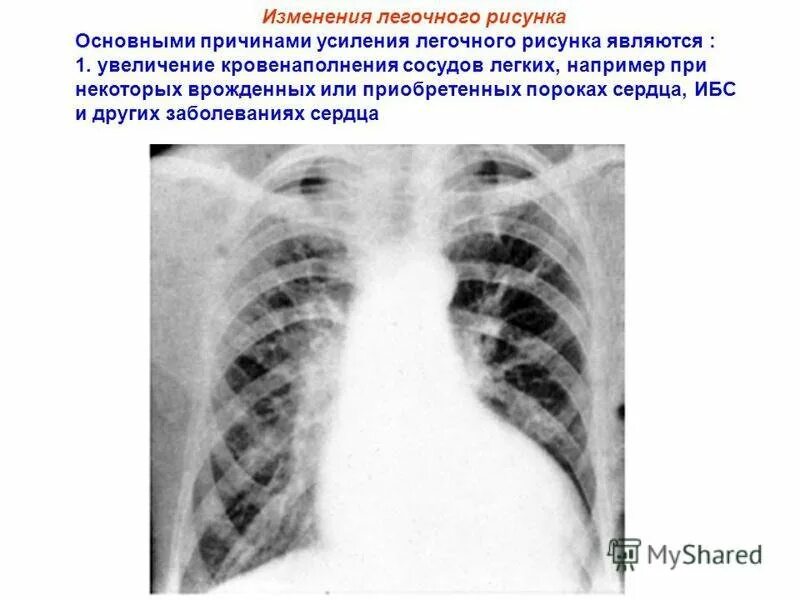 Изменение легочного рисунка. Усиленный легочный рисунок. Усиление легочного рисунка. Легочный рисунок Изменен.