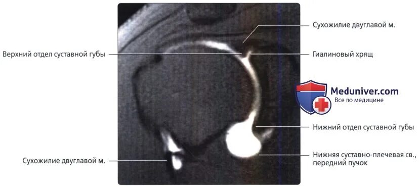Суставная губа гленоида плечевого сустава. Хрящевая губа плечевого сустава. Фиброзно-хрящевая губа гленоида плечевого сустава. Суставной хрящ плечевого сустава норма.