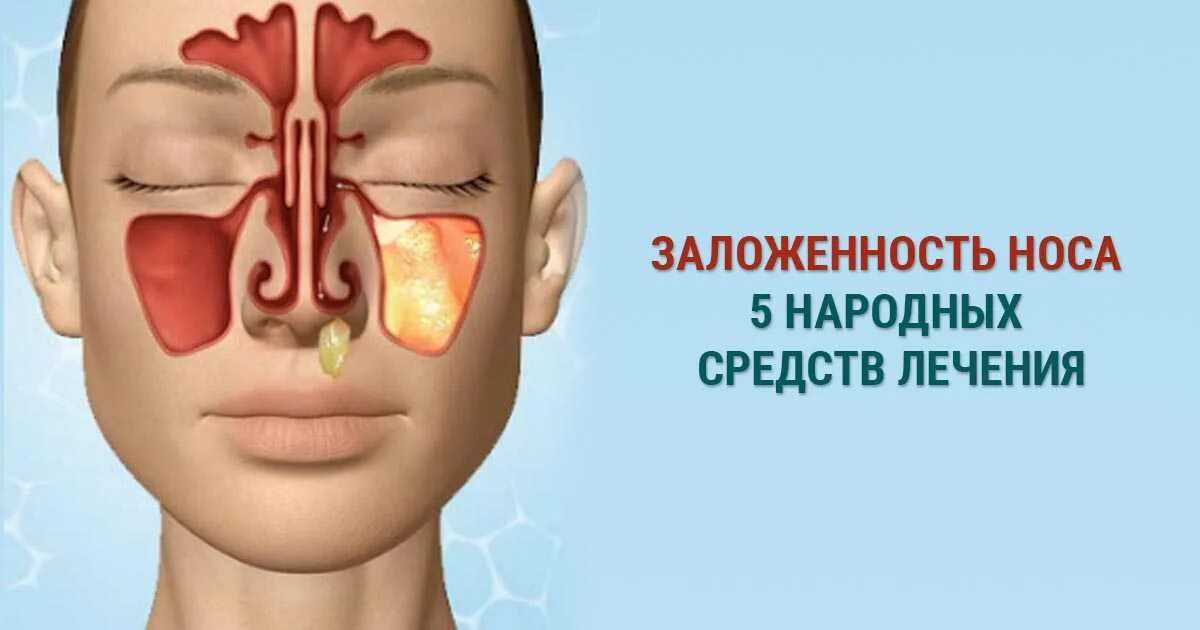 Лечение заложенности носа народными средствами. Аллергический синусит. Народные средства для заложенности носа. Заложенность одной ноздри.