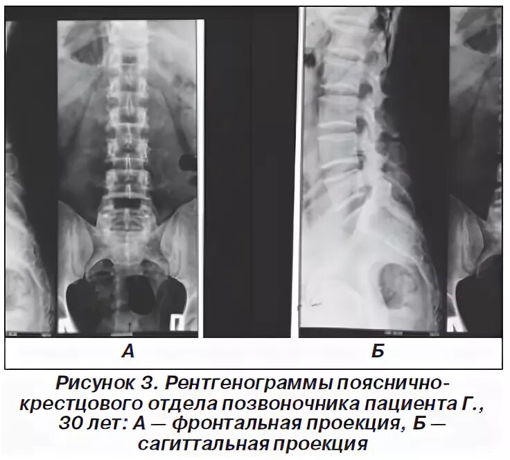 Рентген крестцового отдела позвоночника подготовка. Рентген поясничного отдела норма. Пояснично-крестцовый отдел позвоночника рентген норма. Рентген поясничного отдела в 2 проекциях. Поясничный отдел позвоночника рентген норма.