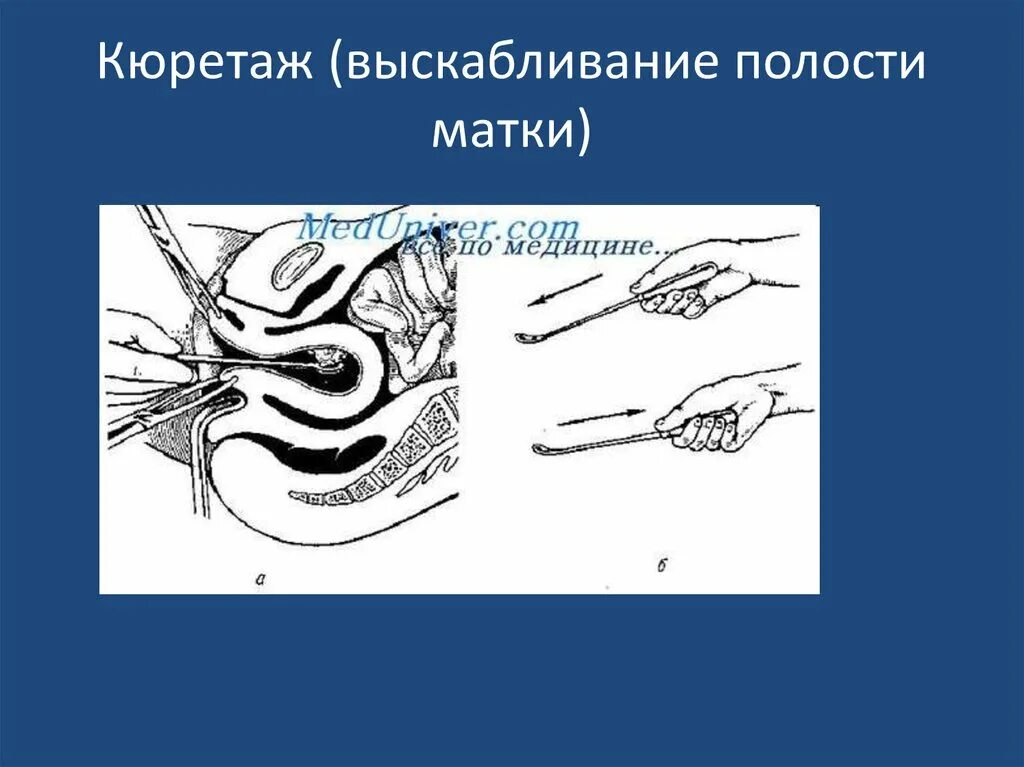 После выскабливания цервикального канала. Выскабливание полости матки инструментарий диагностическое. Выскабливание цервикального канала шейки. Кюретажное выскабливание это.