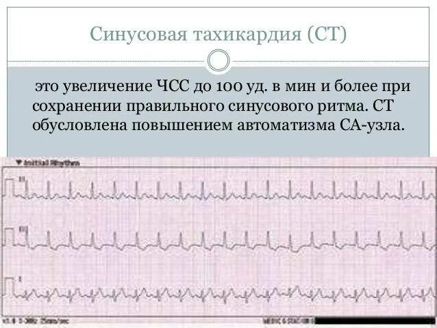 Синусовая тахикардия вертикальное. Синусовая тахикардия ЧСС 100 ЭКГ. Синусовая тахикардия у ребенка 1 год. Синусовая тахикардия ЭКГ признаки. Синусовая тахикардия ЧСС 125.