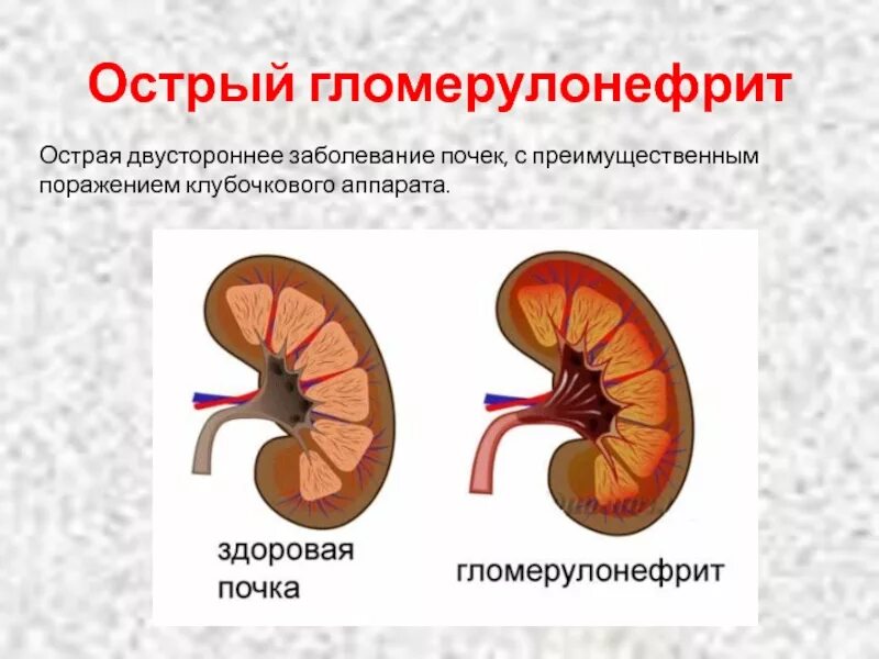 Острый серозный гломерулонефрит. Хронический гломерулонефрит почка. Клубочковый аппарат почек. Поражение клубочков почек