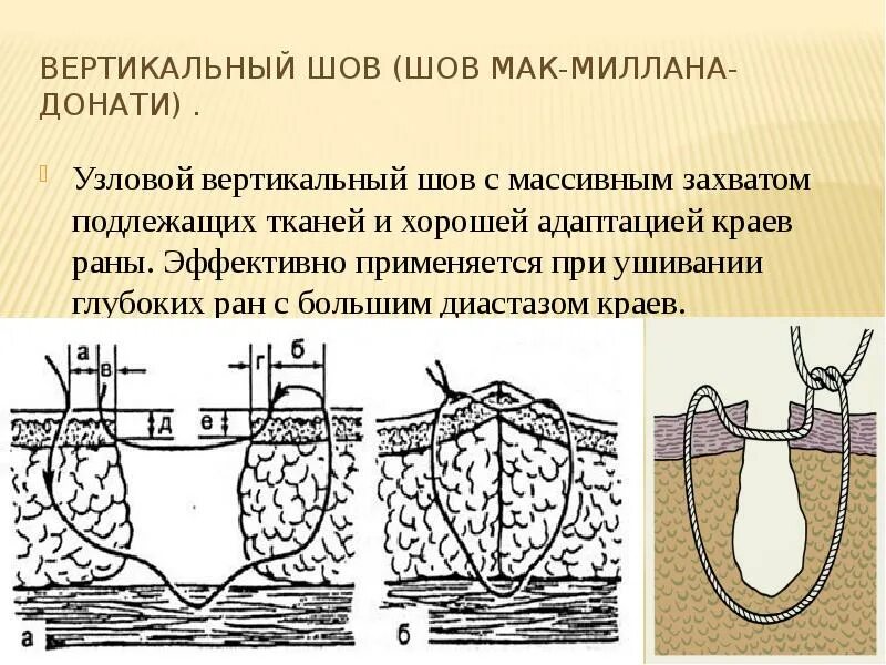 Шов макмиллана донати матрацный шов. Шов по донати техника. П образный вертикальный шов по донати. Шов мак-миллана –донати. Шов мак-миллана –донати.