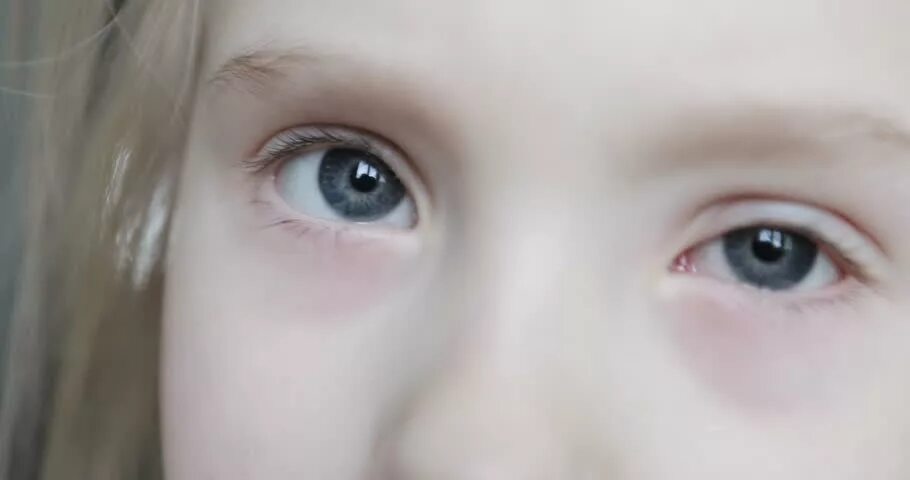 абсцедирующий халязион. ячмень ребенок 4 года. покраснение под глазом у ребенка. ячмень ребенок 4 года. ячмень блефарит халязион.