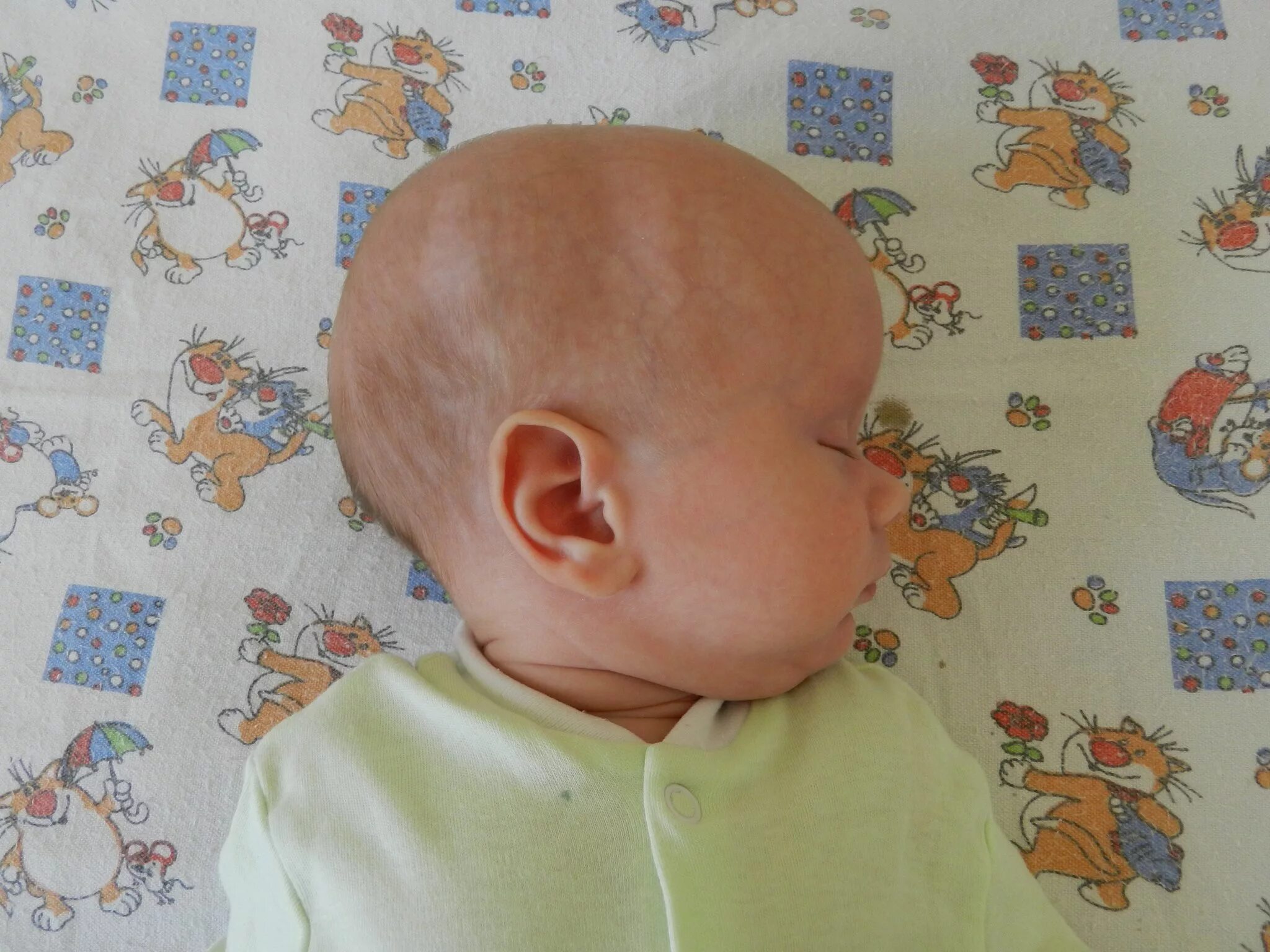 Рахит облысение затылка. Гиперцифалия. Измерение окружности голов. У ребенка увеличивается голова. Риногенная гидроцефалия.