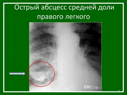 Острый абсцесс