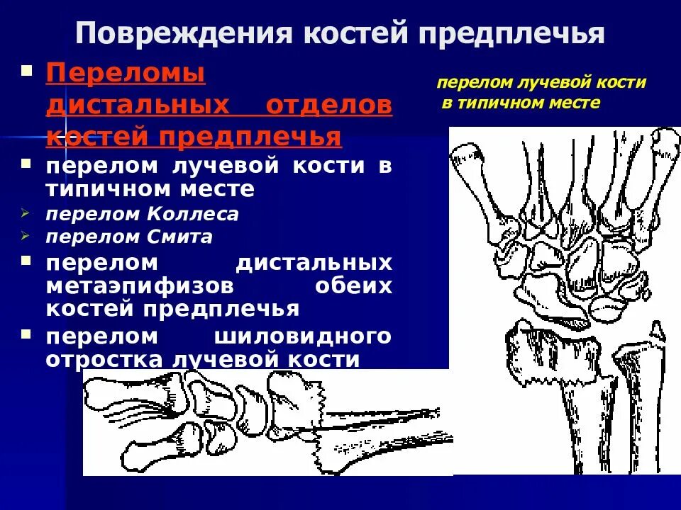 Диагноз перелома лучевой кости. Перелом дистального метаэпифиза левой лучевой кости. Переломы дистальных метаэпифизов костей предплечья. Отрыв кости перелома шиловидного отростка лучевой кости. Перелом луча в типичном месте - перелом метаэпифиза.