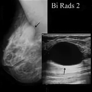 Кисты bi rads 2. Фиброзно кистозная мастопатия молочной железы bi-rads-4a. Молочная железа фиброаденома bi-rads 2. Что такое фиброаденома правой молочной железы , bi-rads 2. Молочная железа категория bi-rads 2.