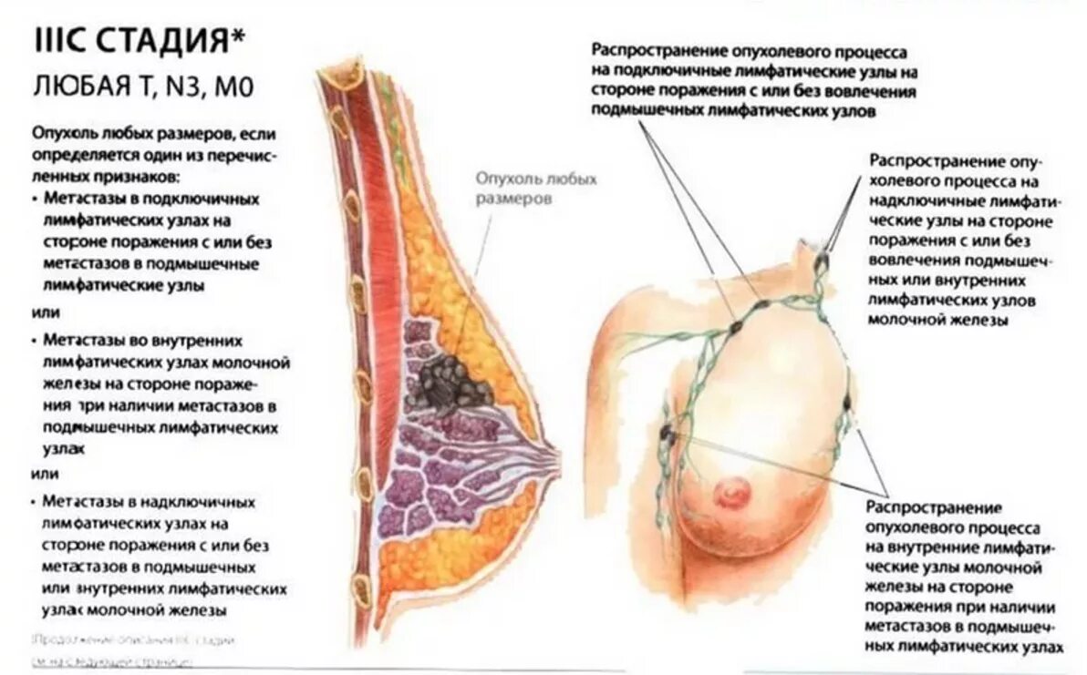 Злокачественное новообразование молочной железы. Лимфоузлы млоочно йжелезхы. Внутренние лимфатические узлы молочной железы. Опухолевые процессы в груди. Увеличен лимфоузел в молочной железе