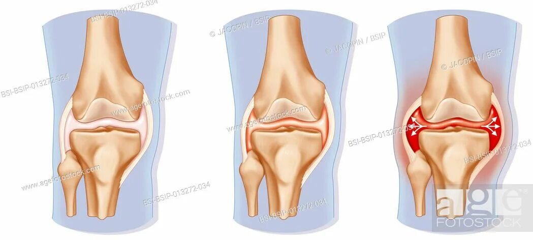 Повреждение коленного сустава 3 степени. Гемартроз коленного сустава при травме.