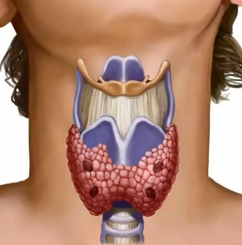 Гиперплазия щитовидной железы что это такое. Зоб щитовидной железы болезни. Струма щитовидной железы.