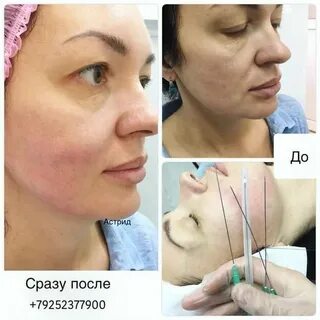 Носогубные складки мезонитями