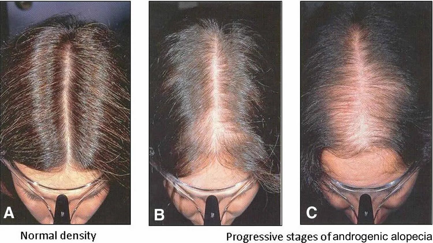 Дарсонваль алопеция андрогенная. Гиперандрогенная алопеция. Ага андрогенетическая алопеция. Андрогенетическая алопеция у женщ.