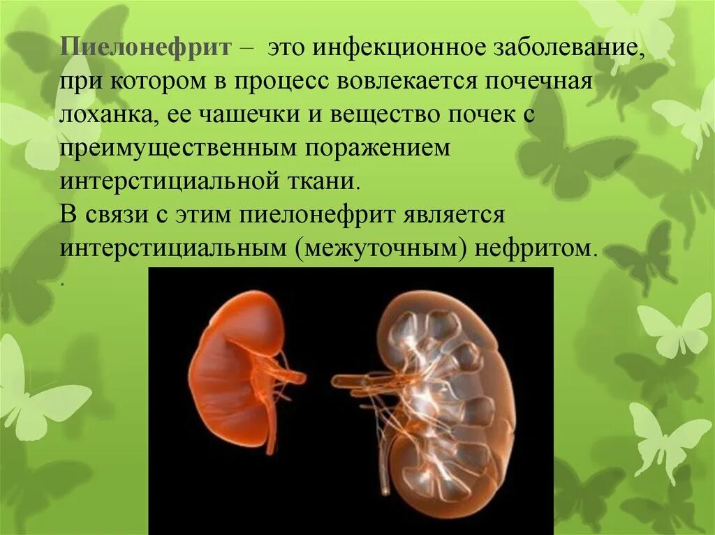 Хроническая болезнь почек пиелонефрит. Нефрит ,пиелонефрит почек. Полинифрит почек хронический пиелонефрит.