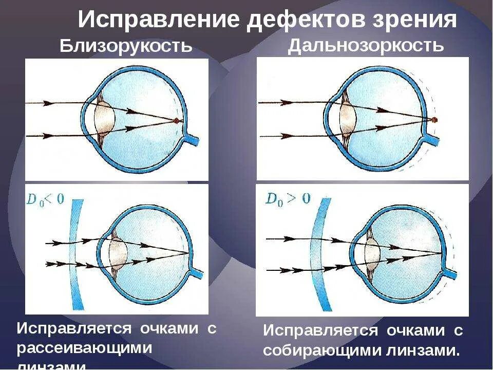 Какое зрение при дальнозоркости. Дефекты зрения близорукость и дальнозоркость. Какими линзами корректируется близорукость и дальнозоркость. Коррекция линзами дефектов зрения. Линзы для коррекции миопии (близорукости).