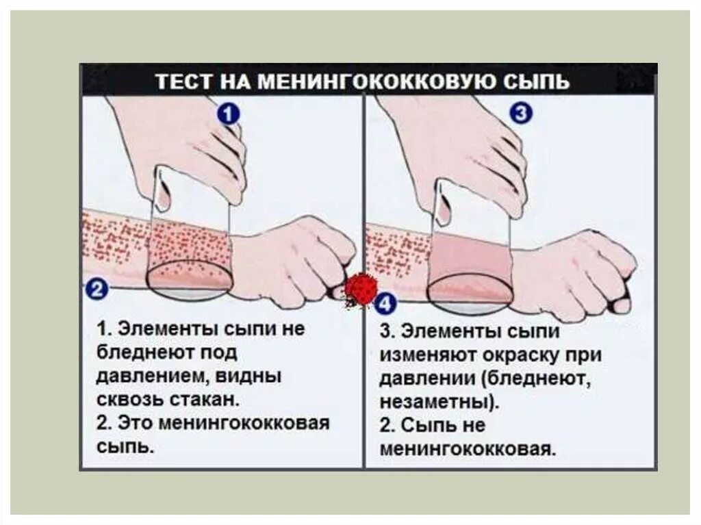 Тест на симптомы. Геморрагическая сыпь менингококк. менингококковая инфекция контагиозная. менингококковая инфекция симптомы интоксикации. сыпь при менингококковой.
