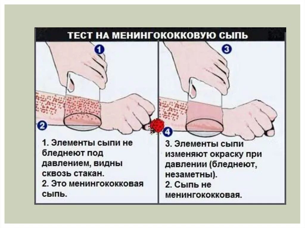 Геморрагическая сыпь при менингококковой инфекции. Звездчатая сыпь при менингите. Менингококковая звездчатая сыпь. Менингококоваяинфнкция.