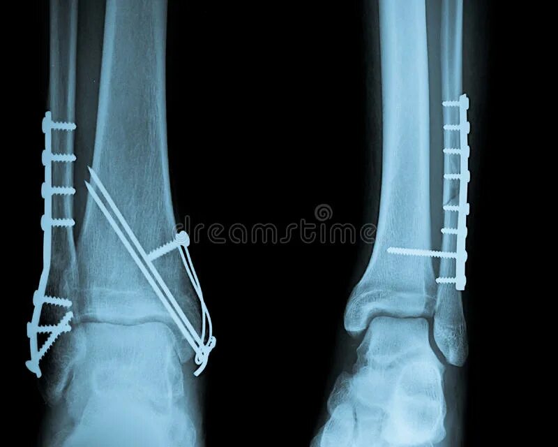 После операции на берцовой кости. Остеосинтез двухлодыжечный перелом. Остеосинтез трехлодыжечный перелом. Перелом лодыжки с остеосинтезом. Перелом голени рентген остеосинтез.