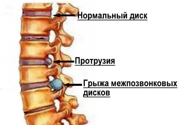 Протрузия межпозвонковых дисков. Протрузия диска позвоночника поясничного отдела. Грыжа протрузия позвоночника. Протрузия дисков позвоночника поясничного крестцового отдела.