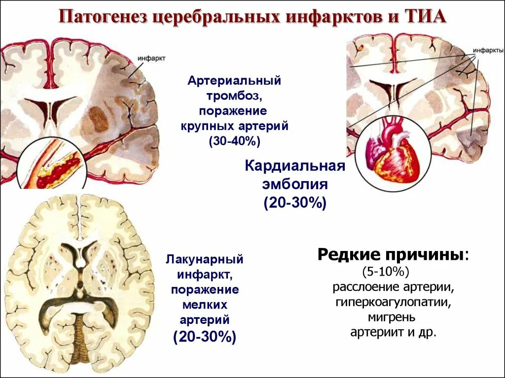 Ишемия мозга причины. Инфаркт головного мозга классификация. Транзиторная ишемическая атака этиология. Ишемический инсульт. Этиология. Клиника. Лечение. Патогенез инфаркта головного мозга.