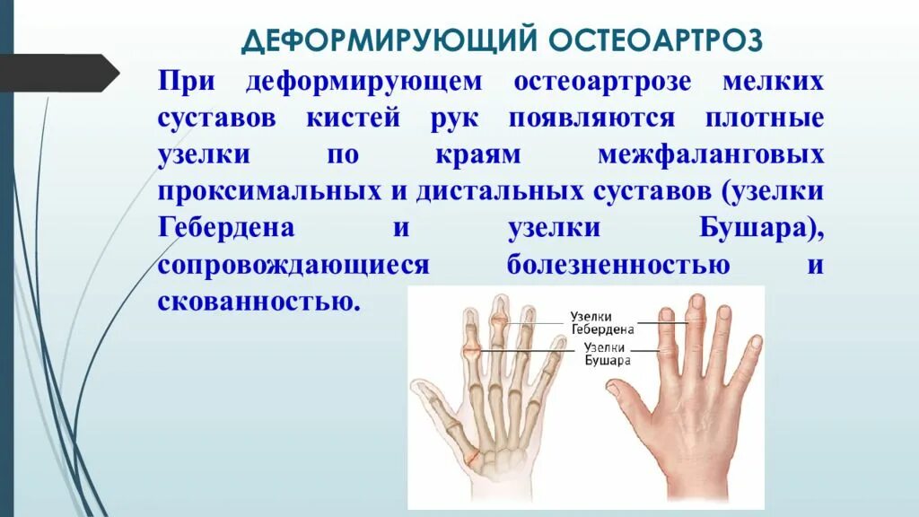 Диагноз доа суставов. Остеоартроз проксимальных межфаланговых. Дистальные межфаланговые суставы кисти. Деформирующий остеоартроз межфаланговых суставов кистей. Деформация межфаланговых суставов.