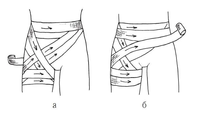 Колосовидная повязка на живот. Колосовидная повязка на тазобедренный сустав. Десмургия колосовидная. Колосовидная повязка на верхнюю треть бедра.