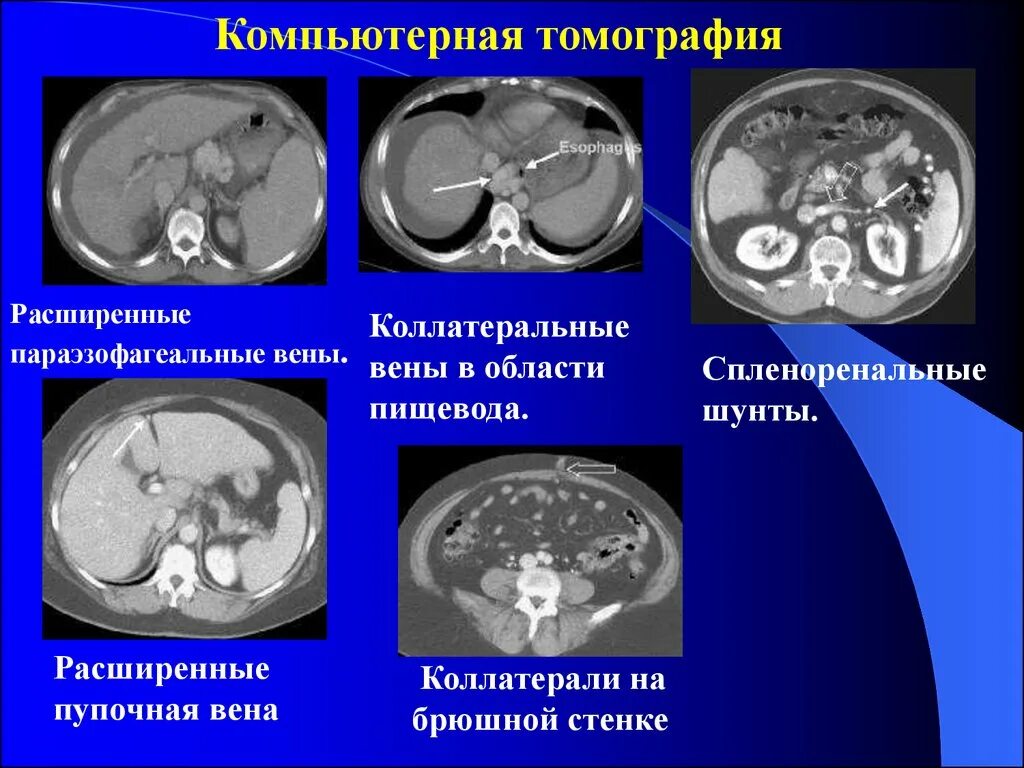 Портальная гипертензия на кт. Признаки портальной гипертензии на кт. Расширение портальной вены на кт. Реканализация пупочной вены на кт. Печень расширены вены