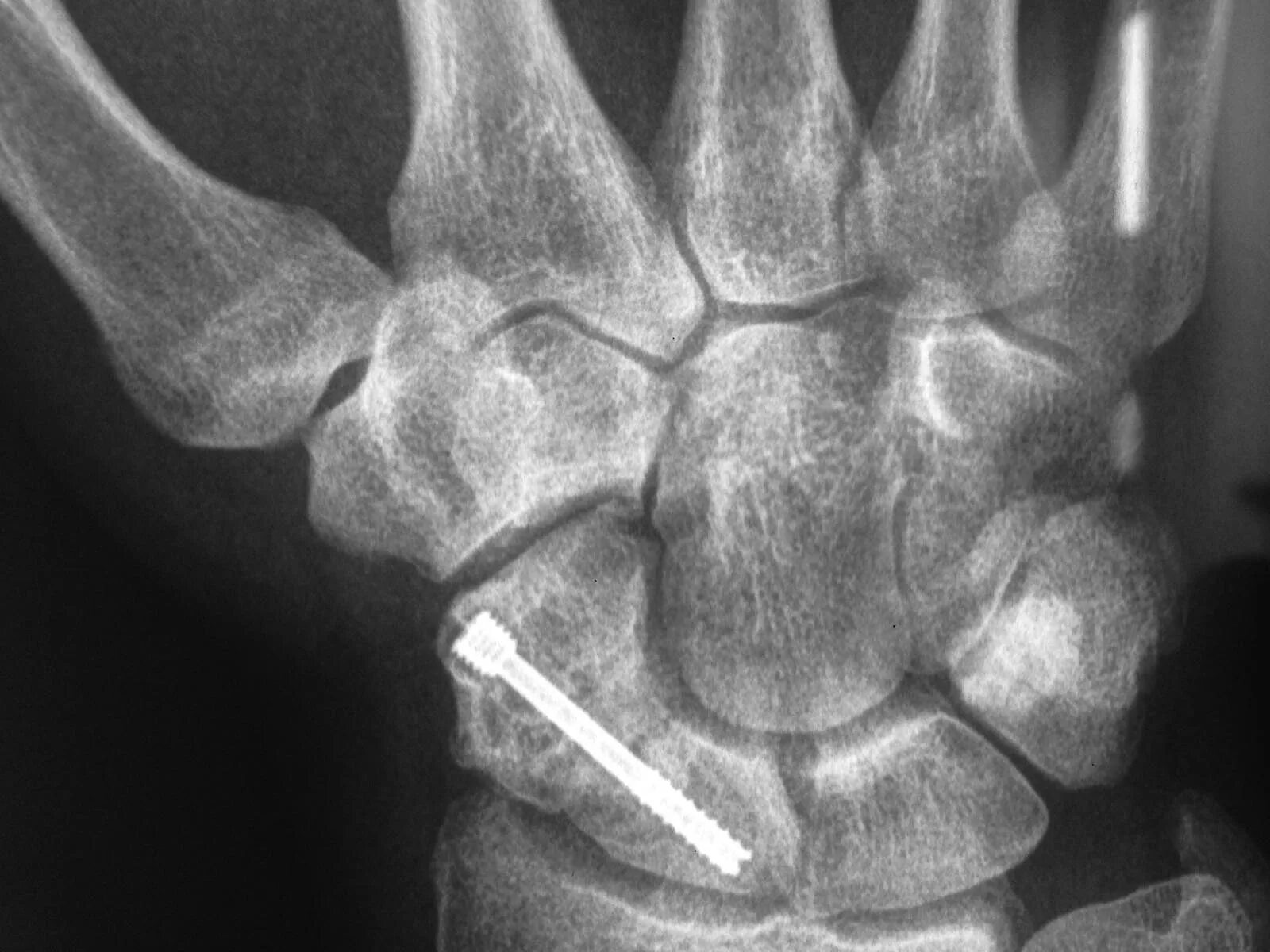 перелом ладьевидной кости кисти руки. несросшийся перелом ладьевидной кости. ладьевидная кость руки перелом. рентген ладьевидной кости кисти. перелом ладьевидной кости рентген.