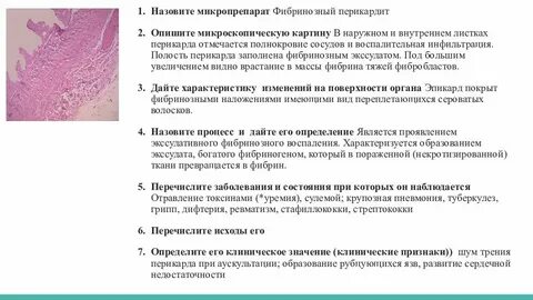 Фибринозный перикардит микропрепарат