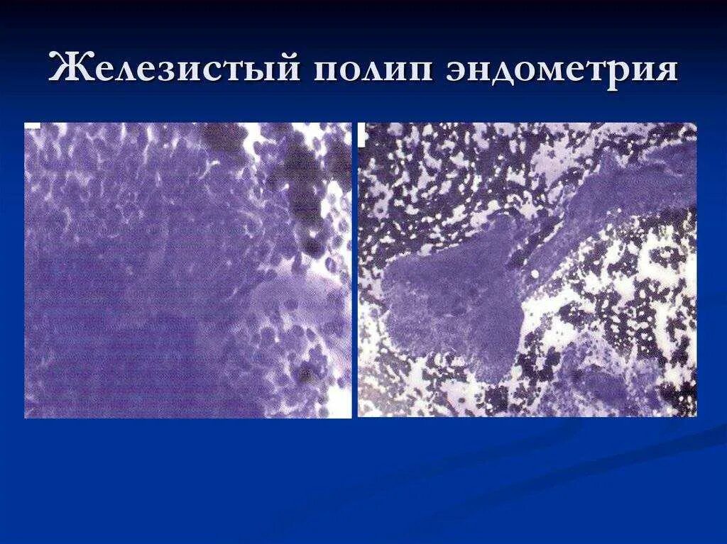 Железистый полип эндометрия гистология. Фиброзный полип гистология. Фиброзные полипы матки микропрепарат. Гистология железисто-фиброзный полип.