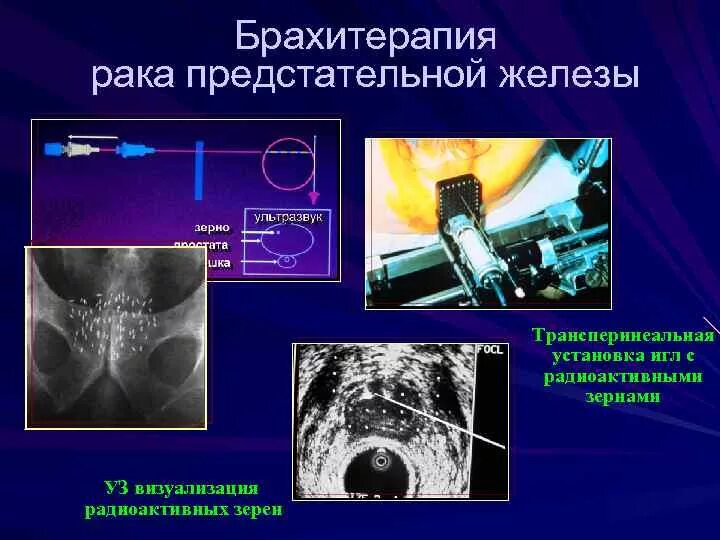 Простата после облучения. Контактная лучевая терапия брахитерапия это. Аппарат лучевой терапии шейки матки. Брахитерапия (внутритканевая лучевая терапия). Брахитерапия предстательной железы низкодозная.