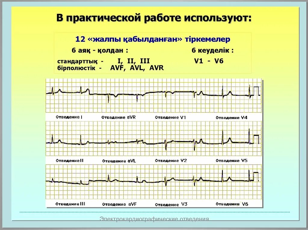 АВЛ отведение на ЭКГ норма. AVF на ЭКГ норма. Отведение AVR на ЭКГ. AVR AVL AVF отведения на ЭКГ. Отведение v1 на экг