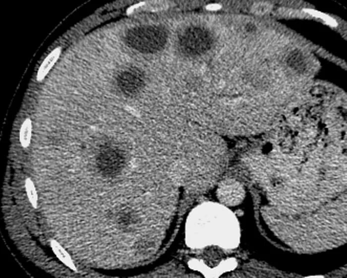 Метастатическое поражение печени. Метастазы меланомы в печень. Метастатическое поражение печени на кт. Рак метастазы в печень лечение